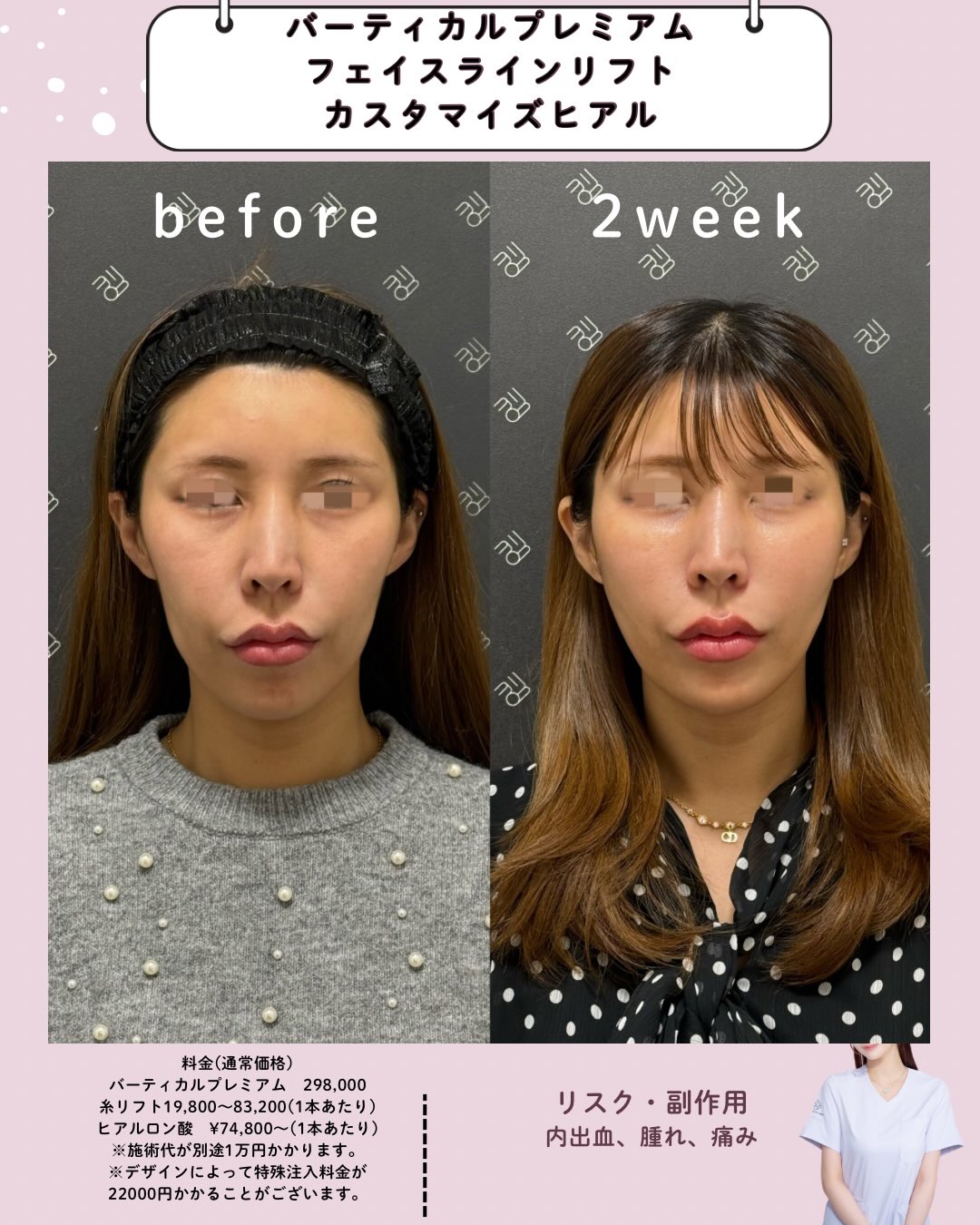 バーティカルリフトプレミアム×糸リフト×カスタマイズヒアルロン酸