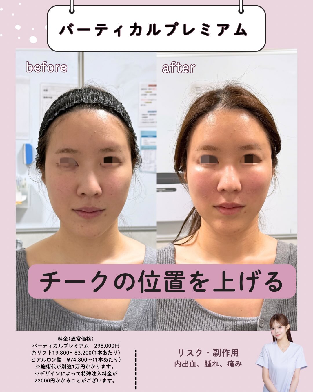 バーティカルリフトプレミアム