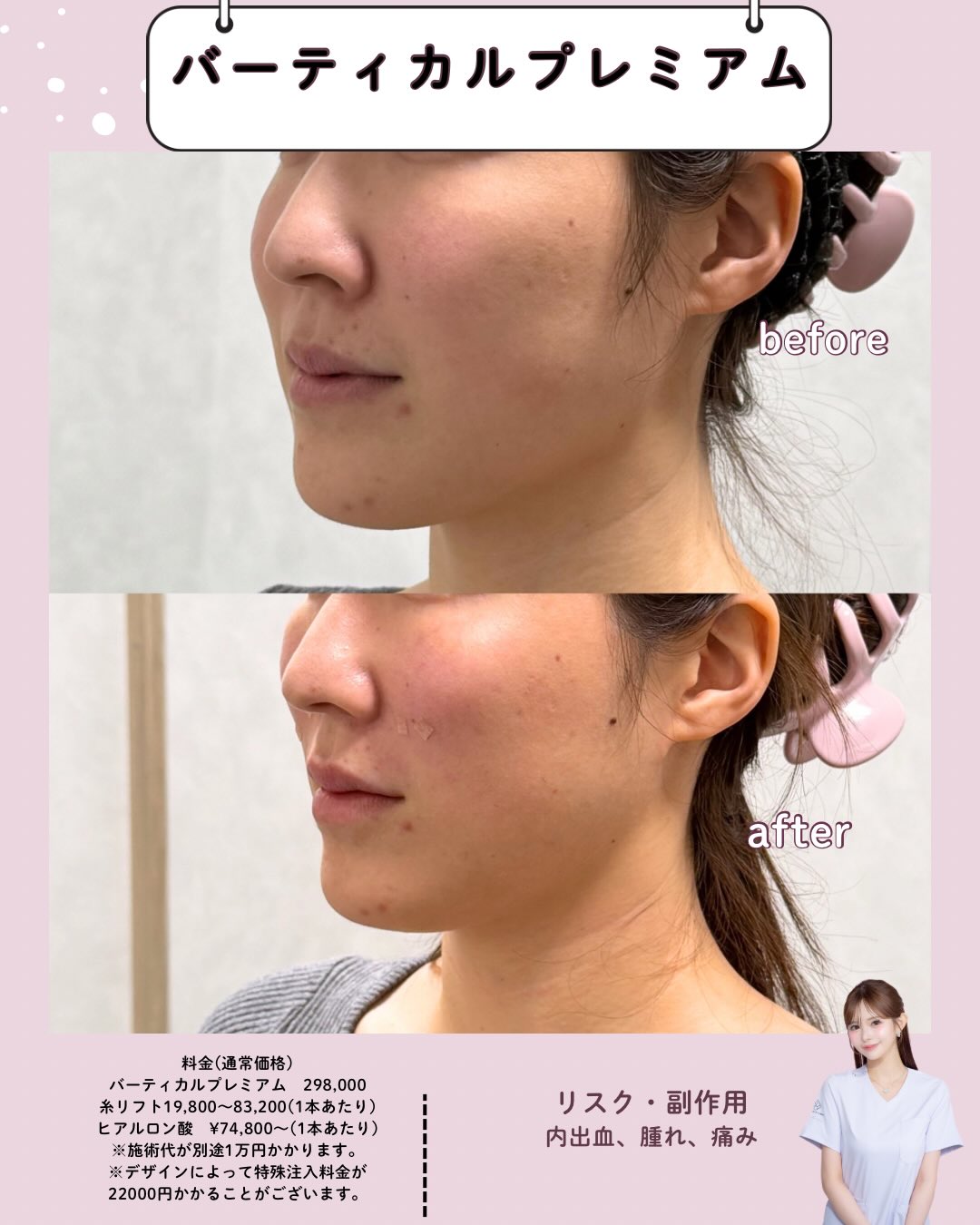 バーティカルリフトプレミアム