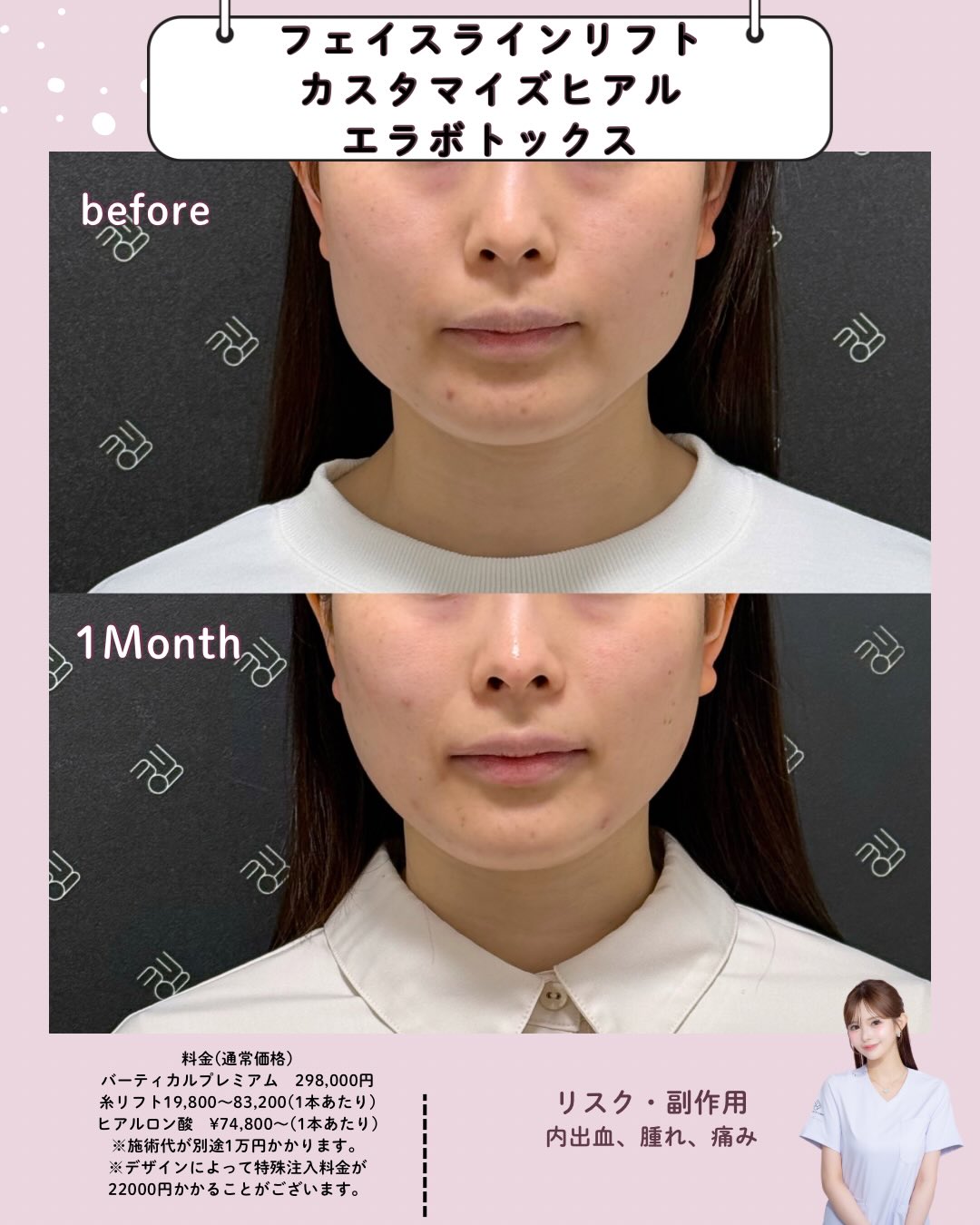 フェイスラインリフト×カスタマイズヒアル×エラボトックス