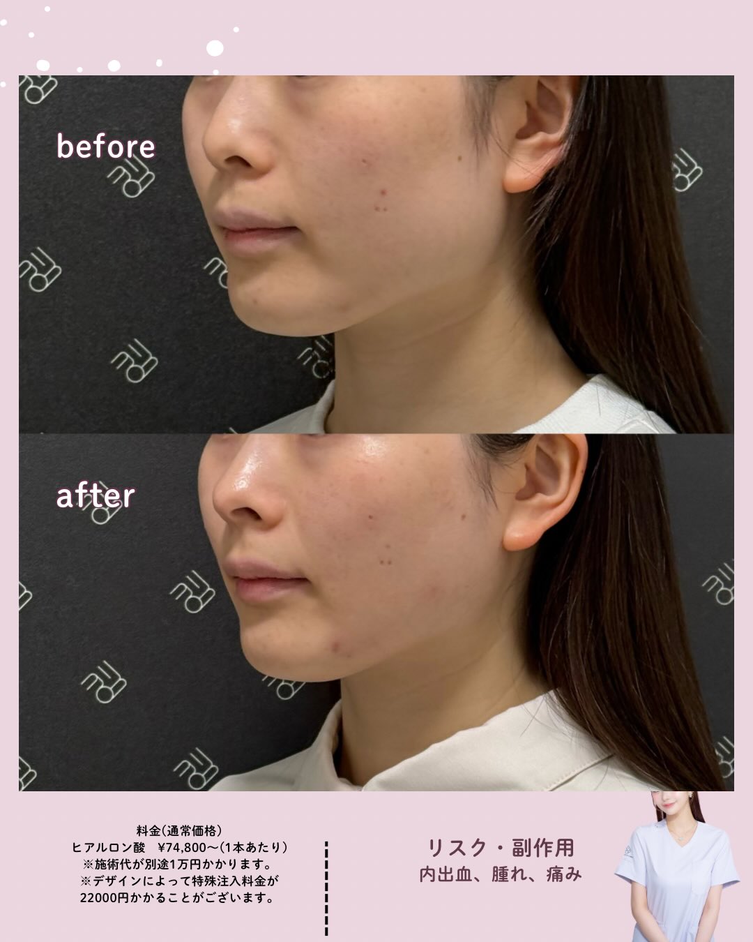 フェイスラインリフト×カスタマイズヒアル×エラボトックス