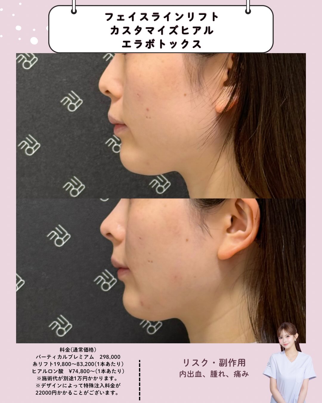フェイスラインリフト×カスタマイズヒアル×エラボトックス