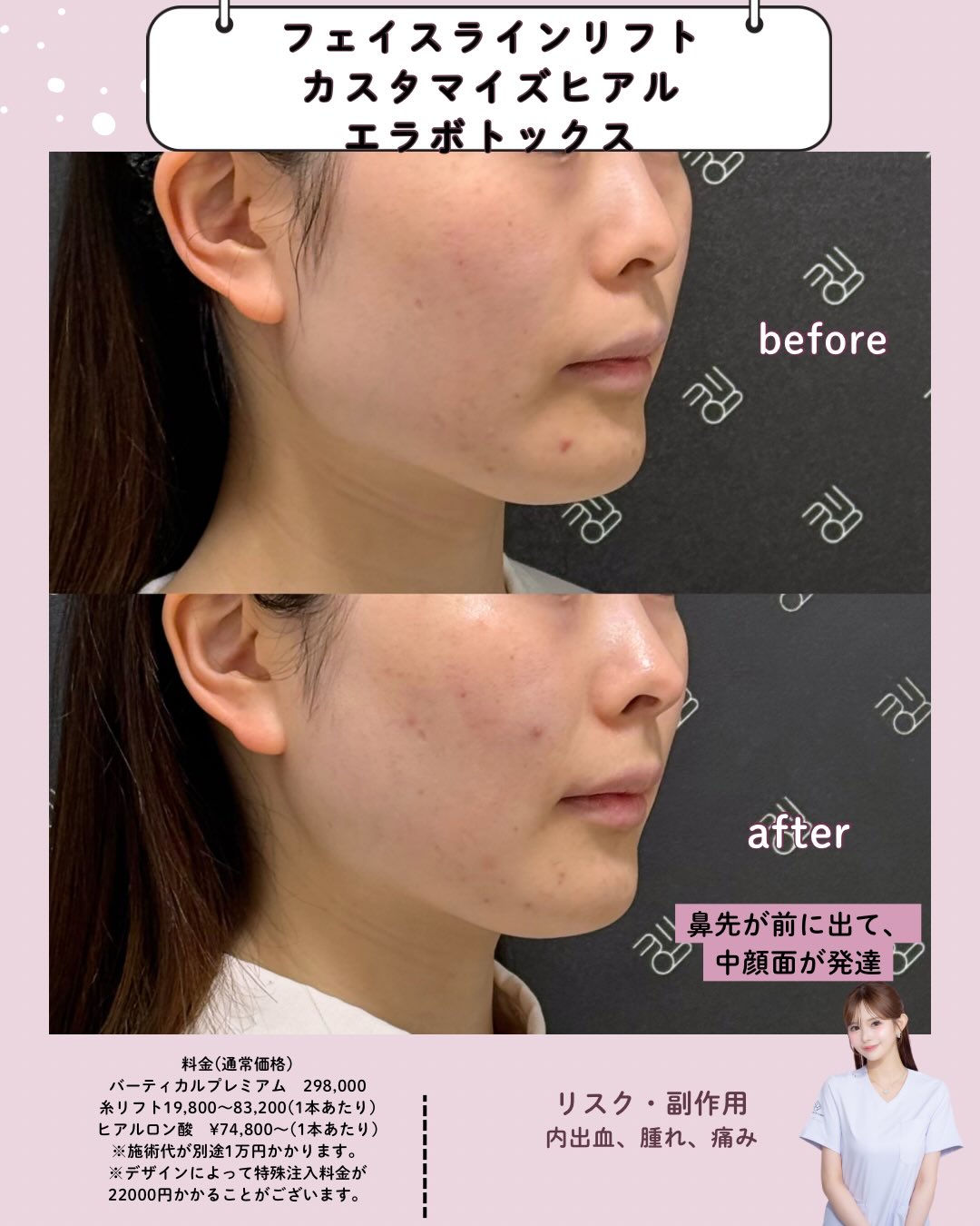 フェイスラインリフト×カスタマイズヒアル×エラボトックス