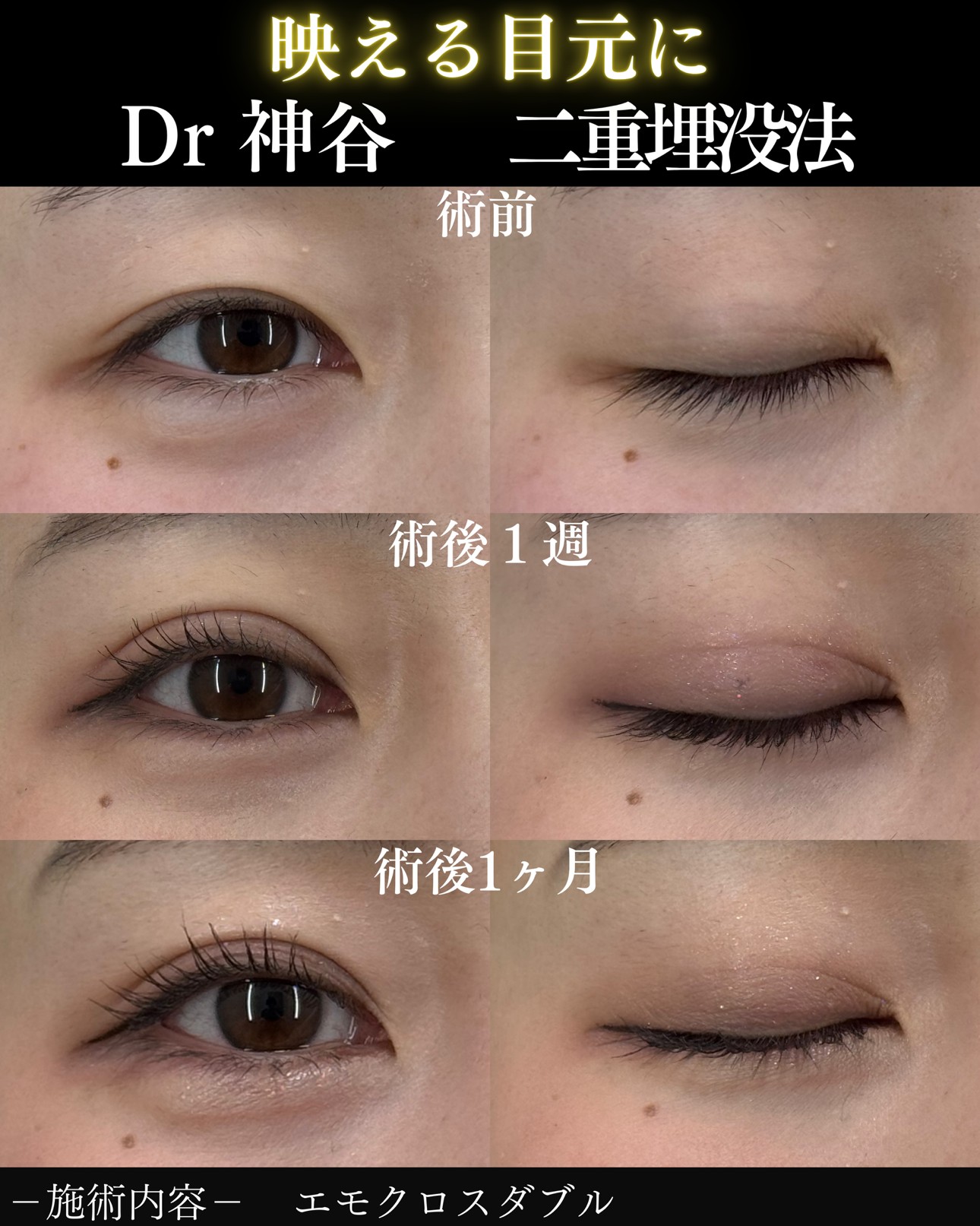 ヒアルロン酸ー症例写真