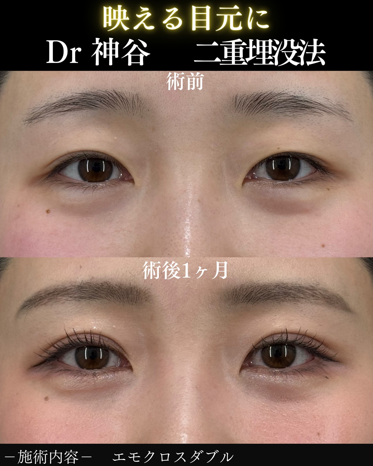 ヒアルロン酸ー症例写真