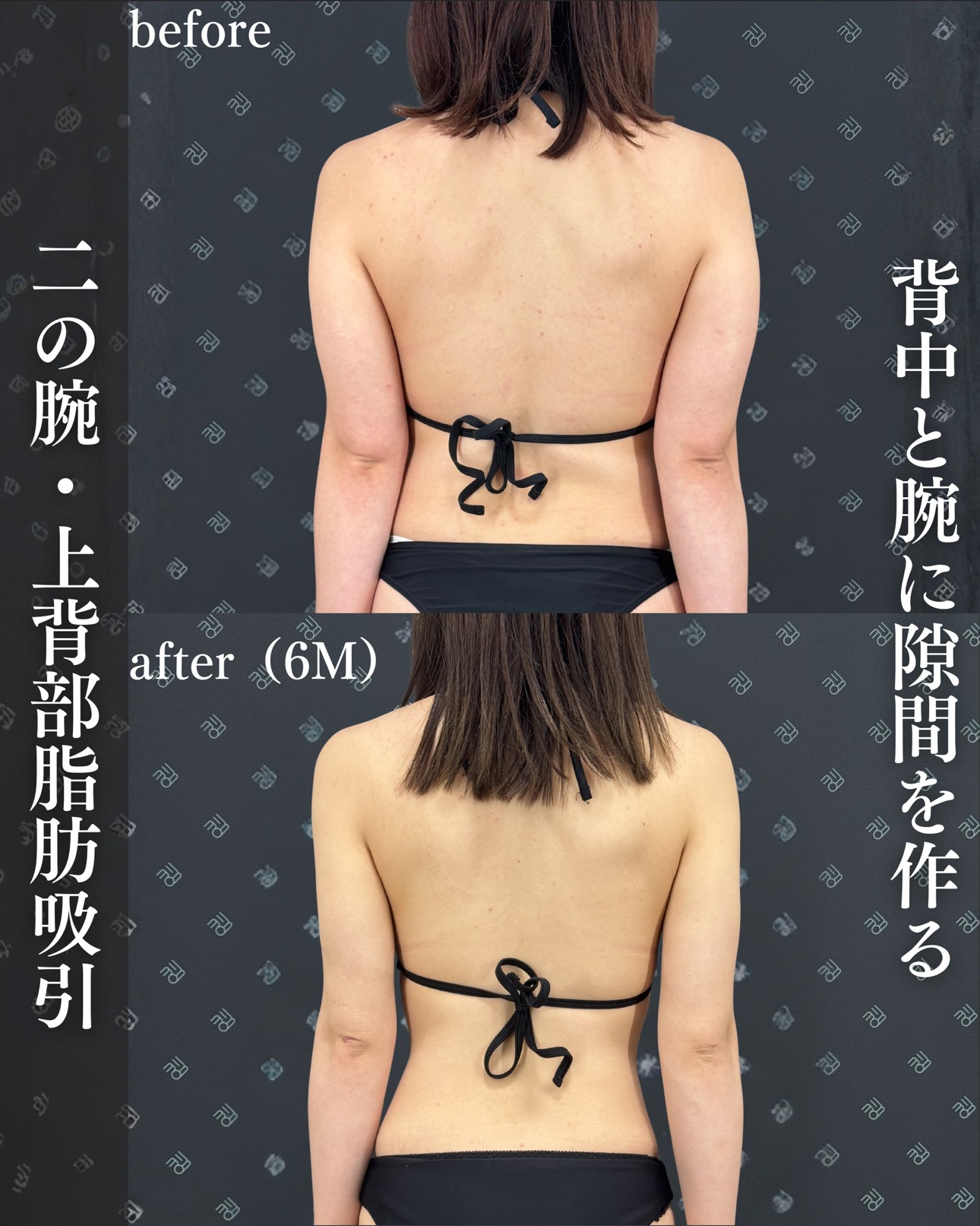 脂肪吸引ー症例写真