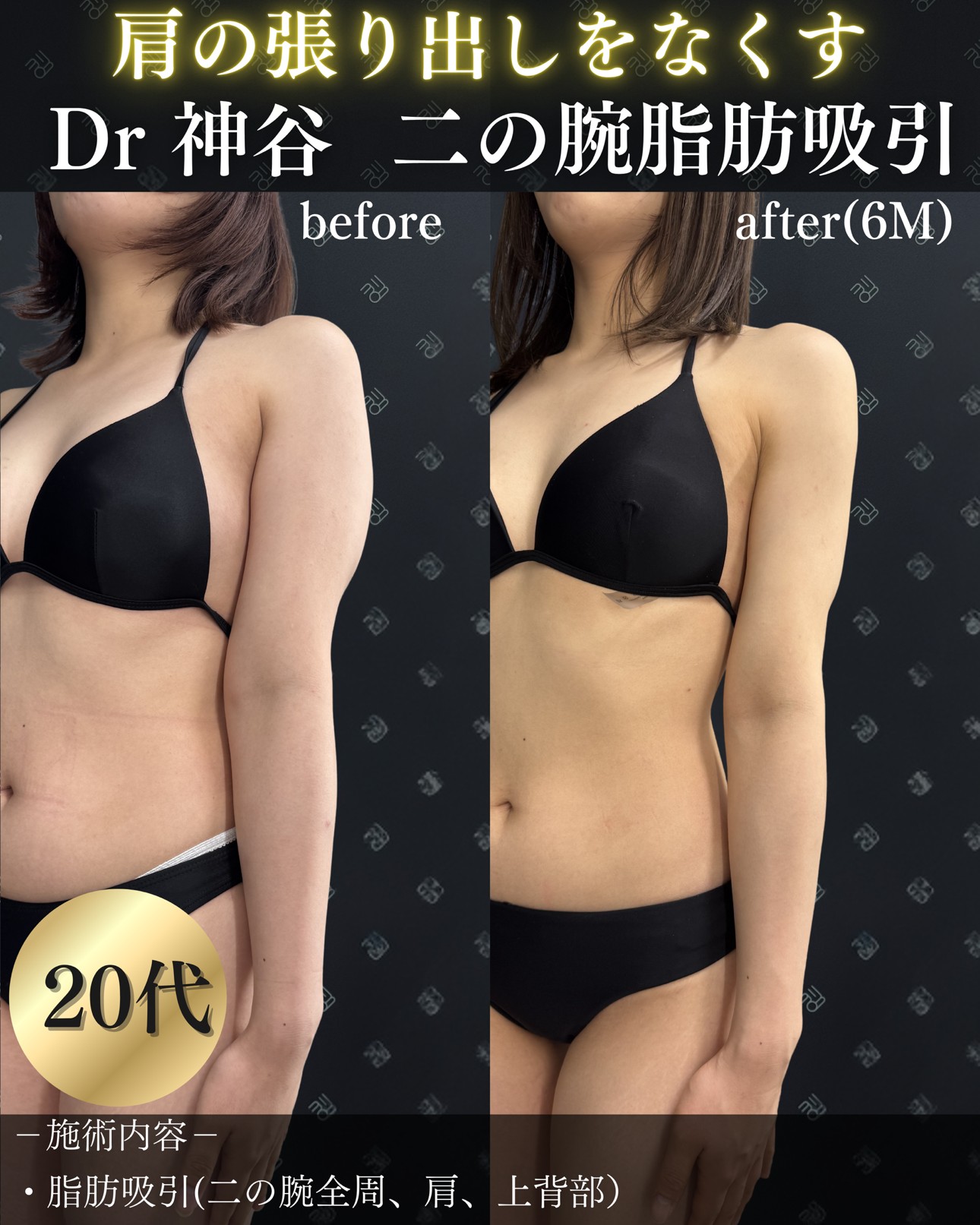 脂肪吸引ー症例写真