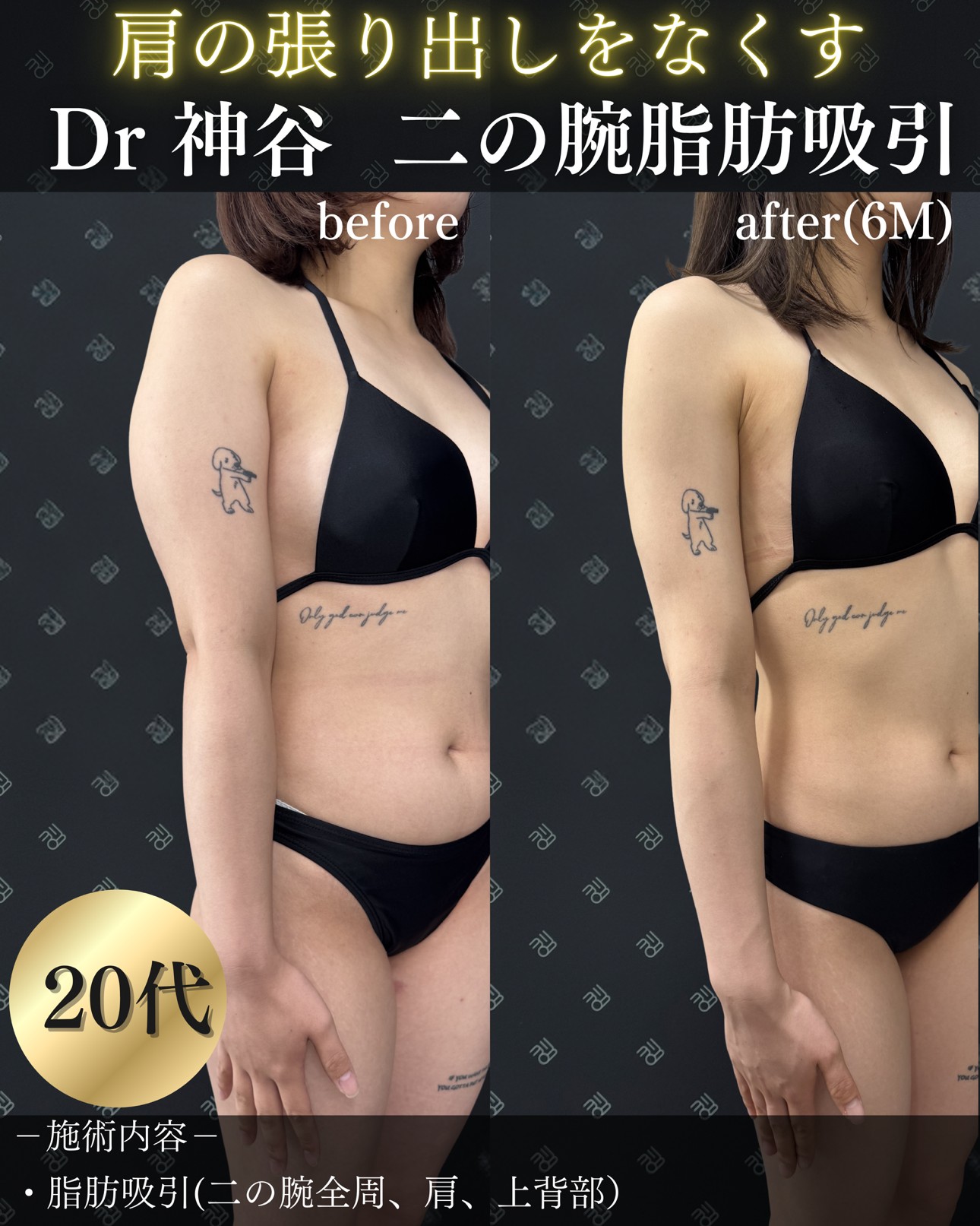 脂肪吸引ー症例写真