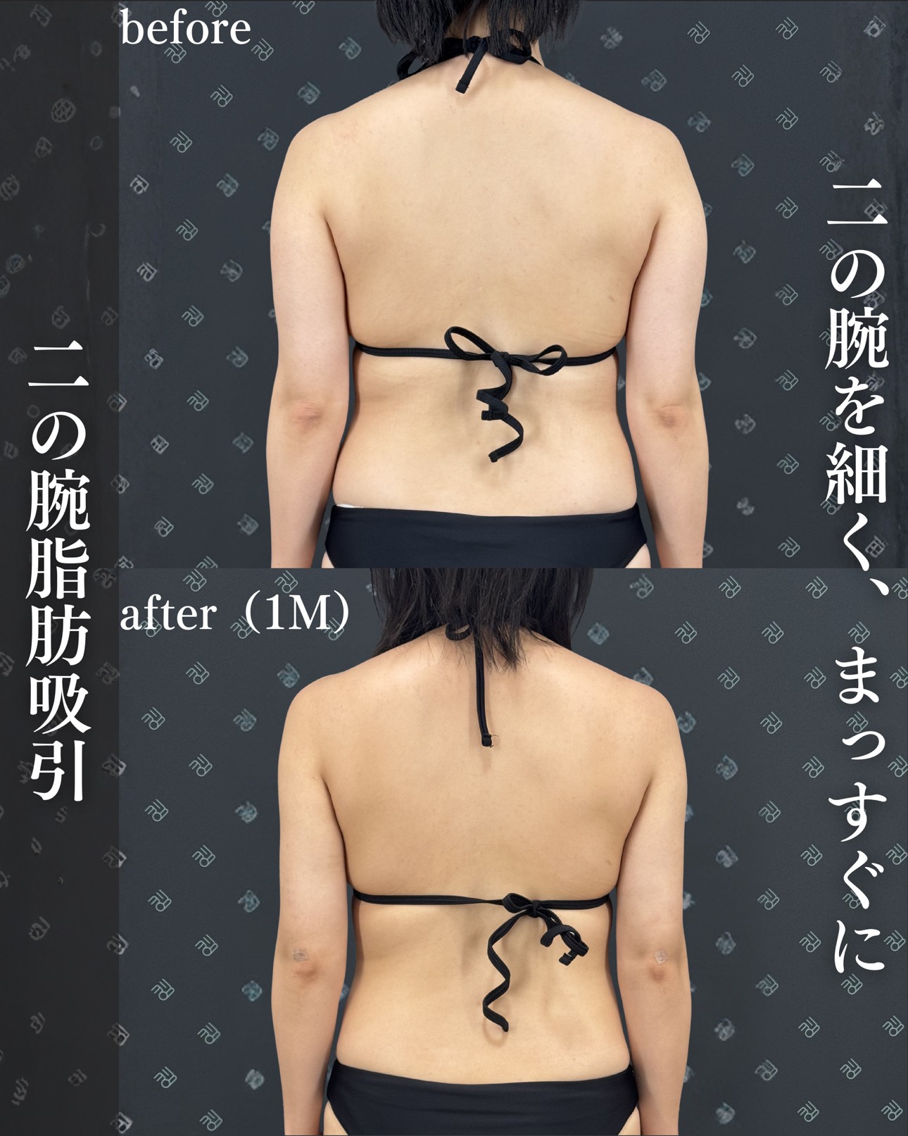 脂肪吸引ー症例写真