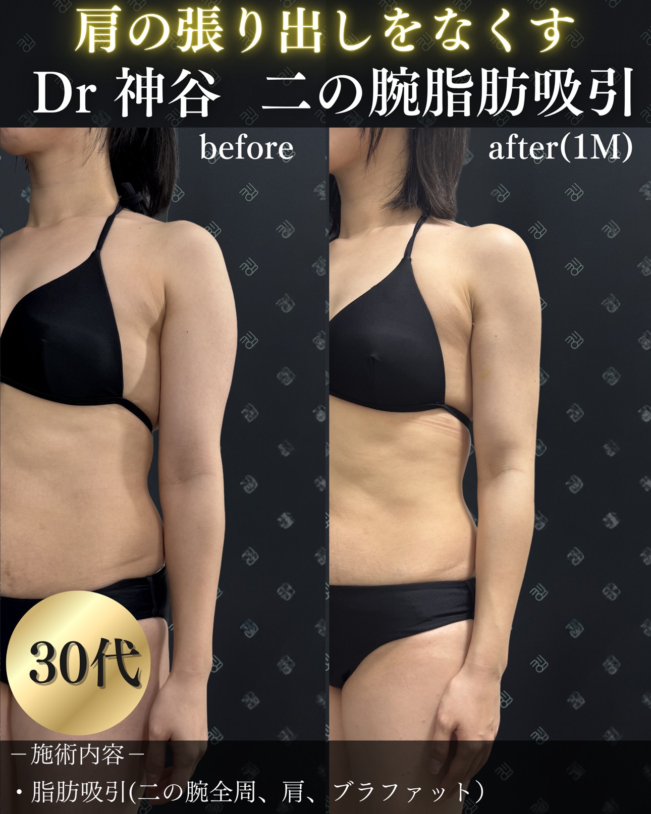 脂肪吸引ー症例写真