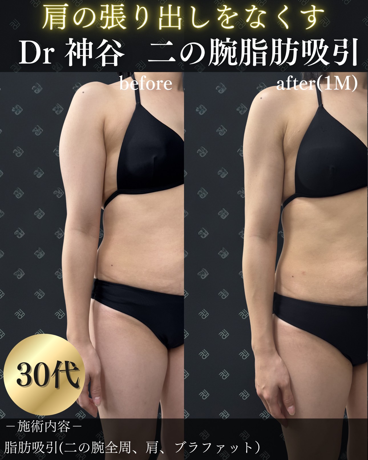 脂肪吸引ー症例写真