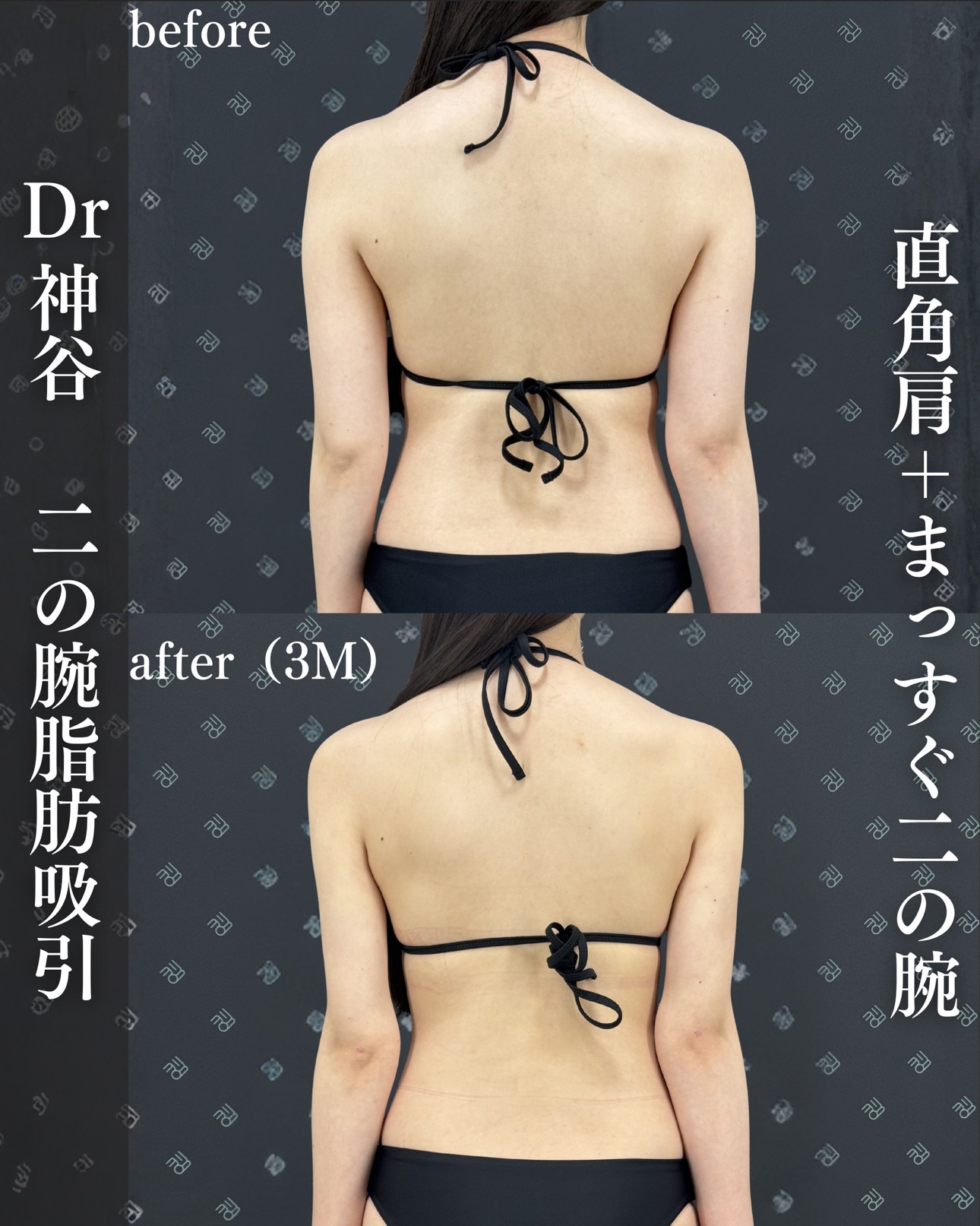 脂肪吸引ー症例写真