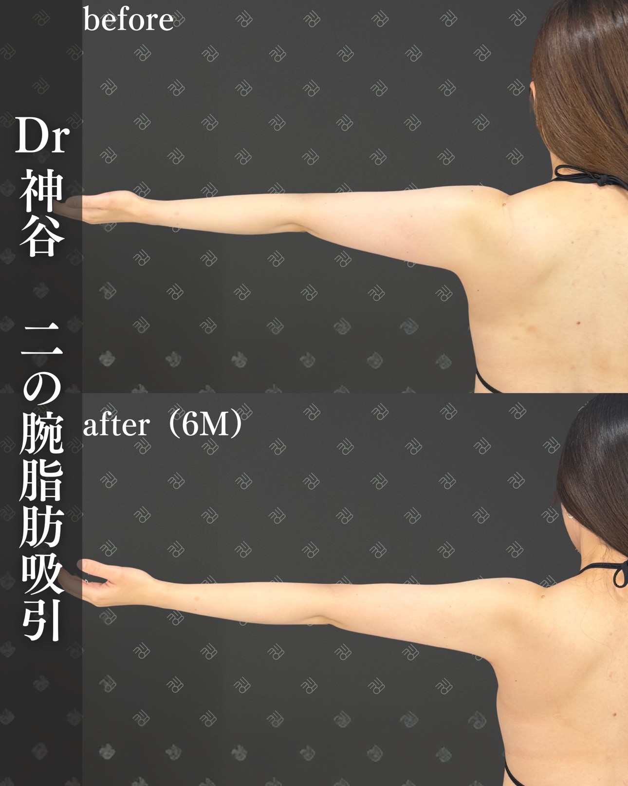 脂肪吸引ー症例写真