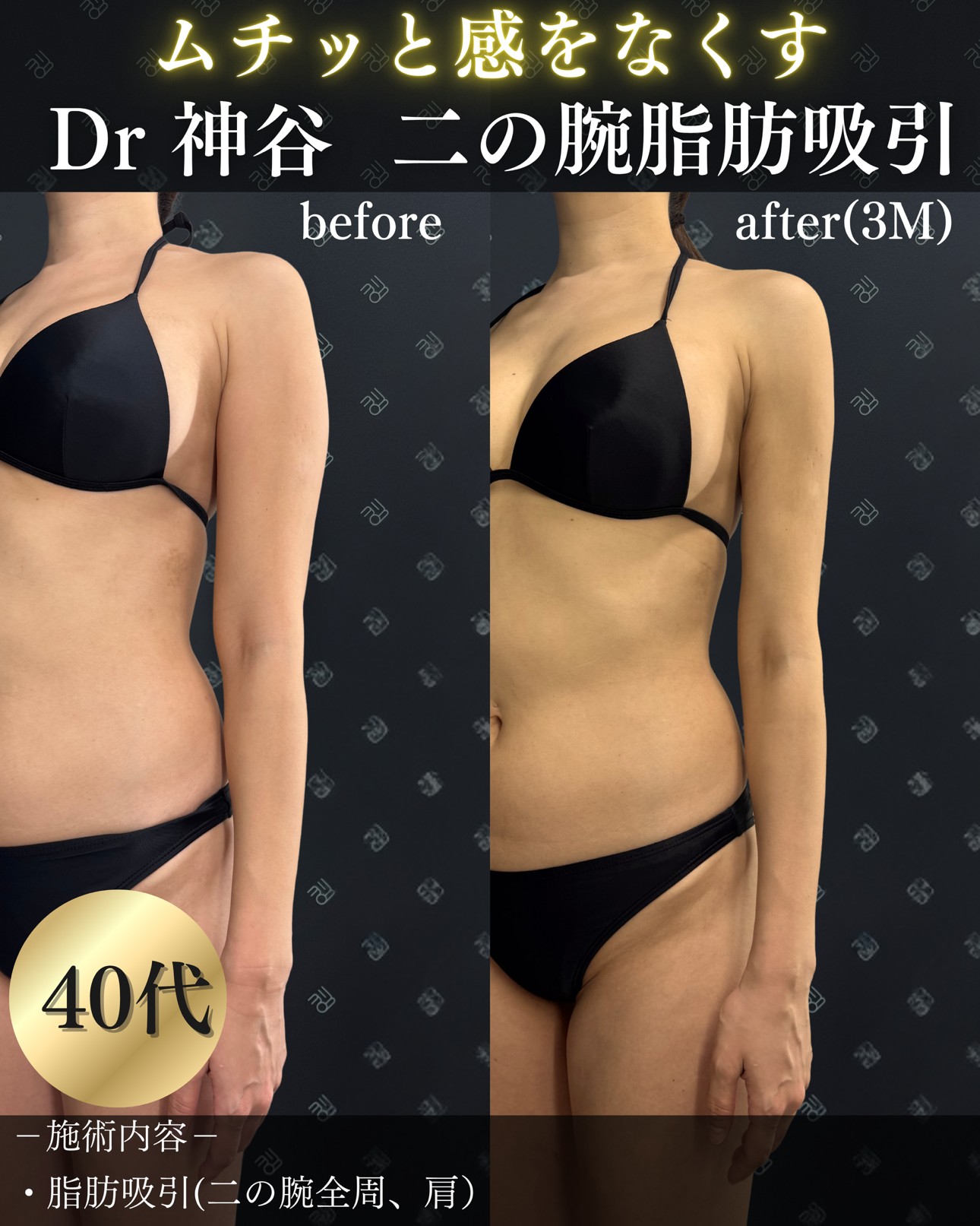 二の腕脂肪吸引ー症例写真