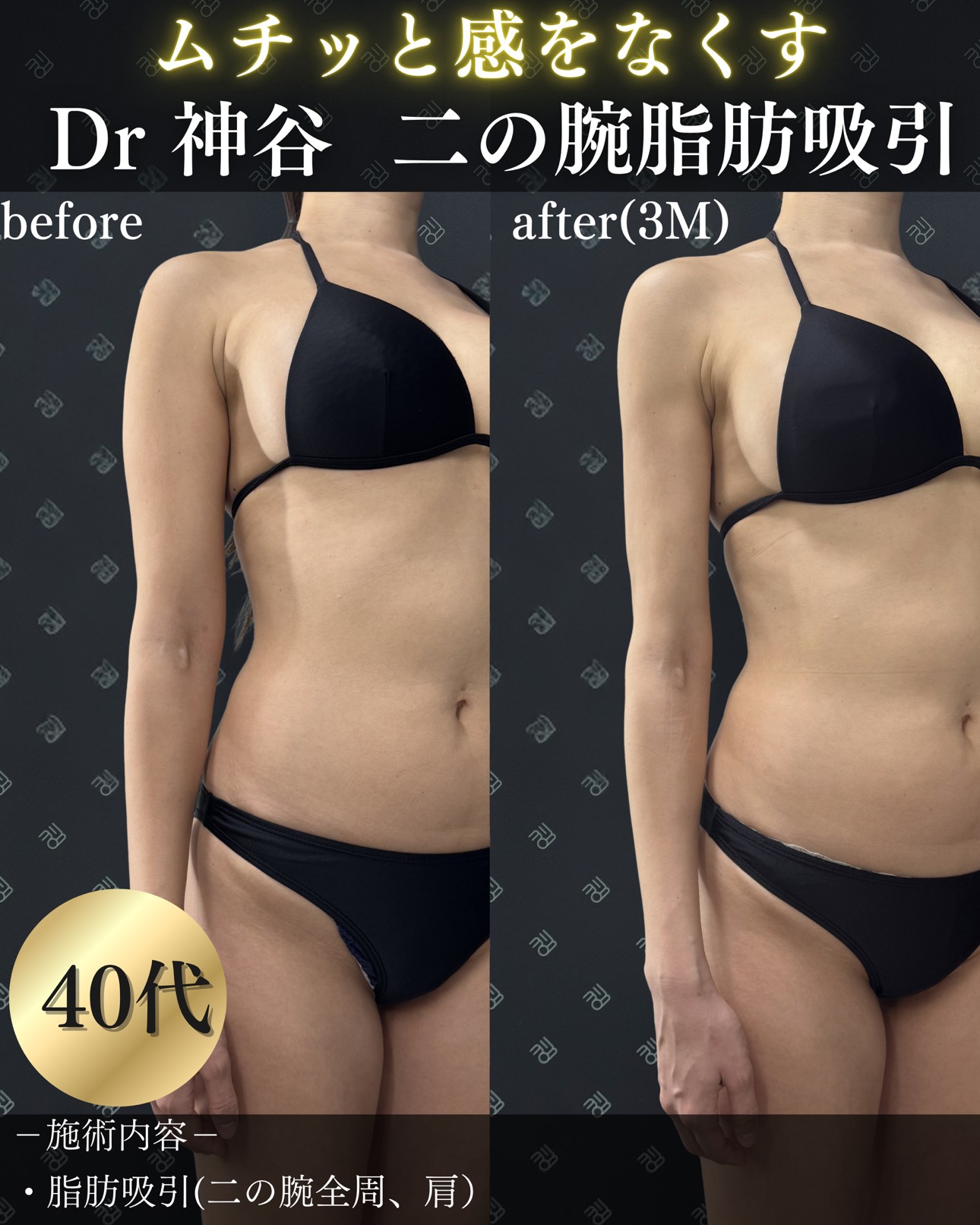 二の腕脂肪吸引ー症例写真