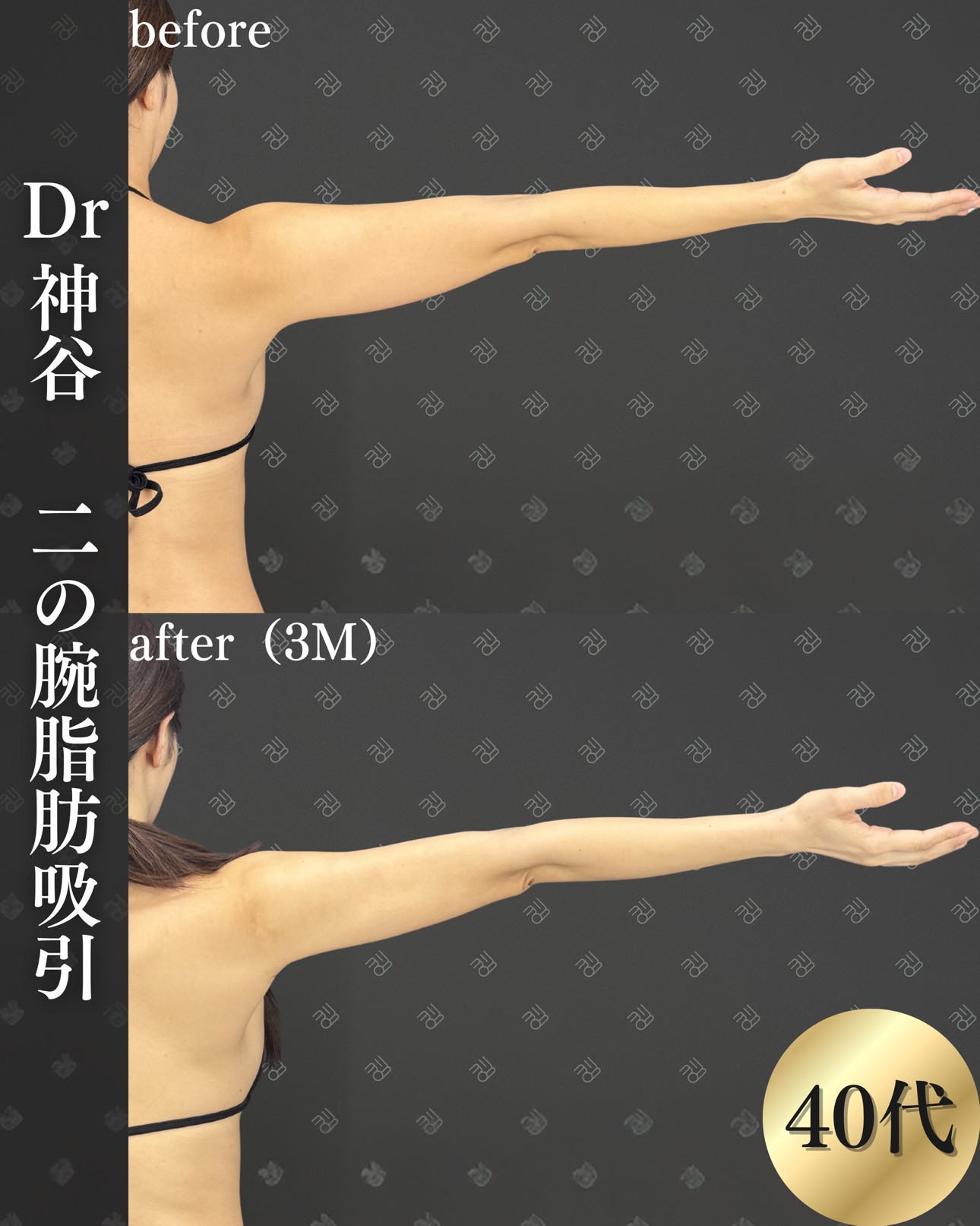 二の腕脂肪吸引ー症例写真