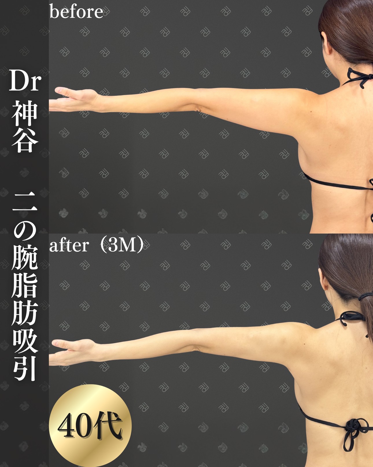 二の腕脂肪吸引ー症例写真