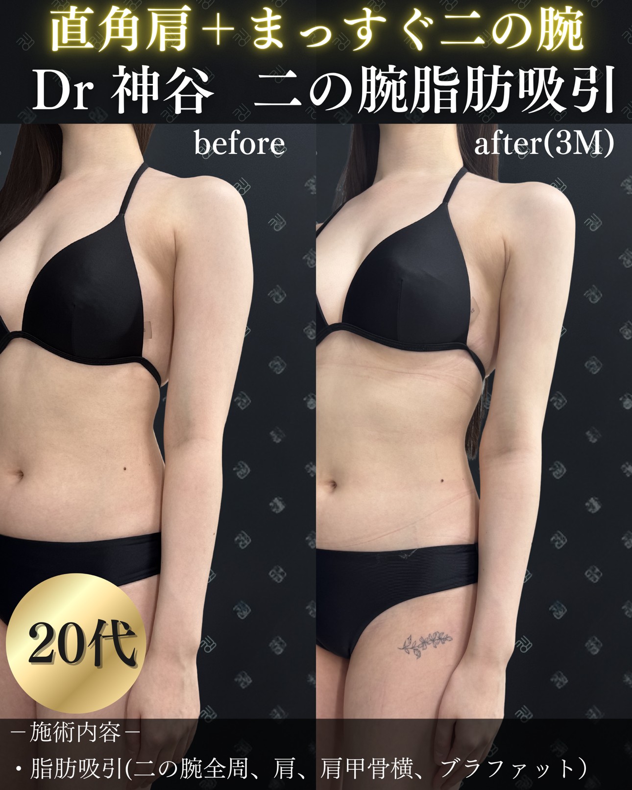 脂肪吸引ー症例写真