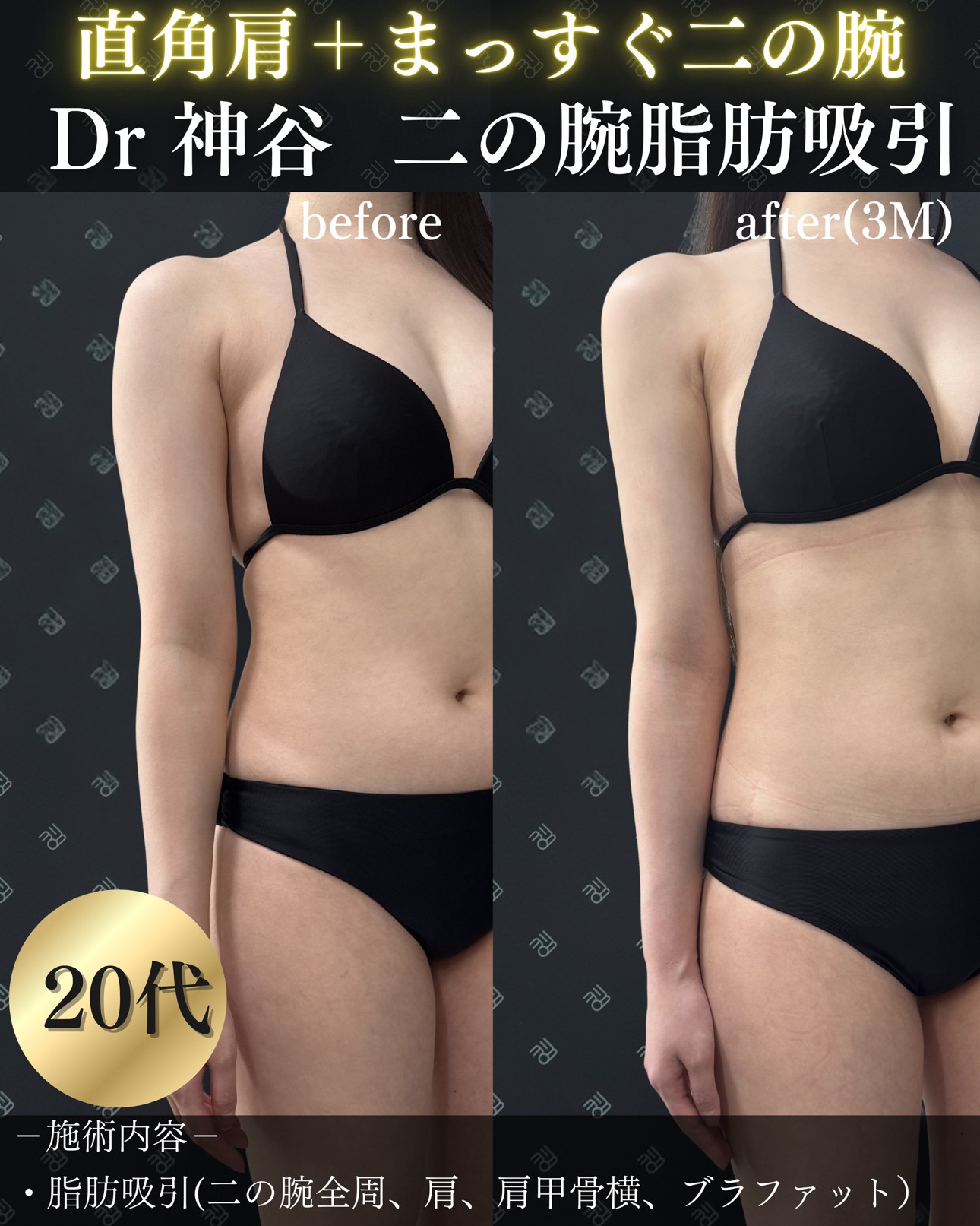 脂肪吸引ー症例写真