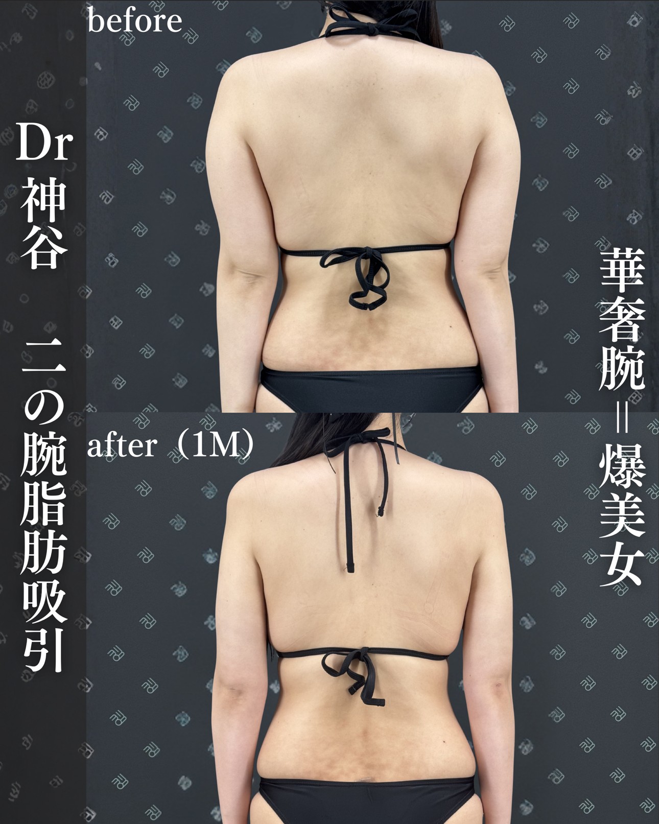 脂肪吸引ー症例写真