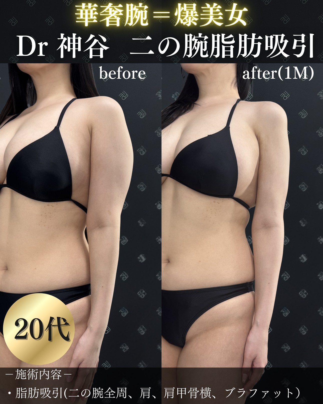 脂肪吸引ー症例写真