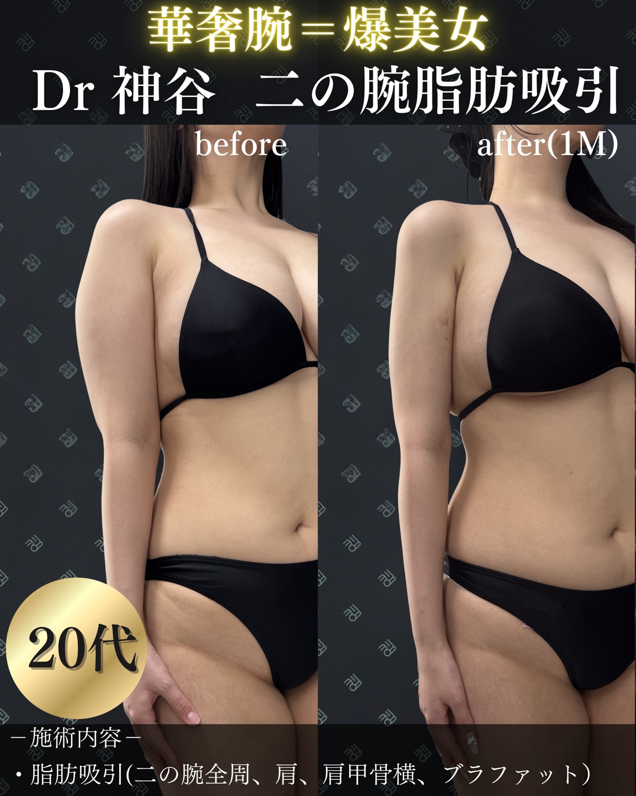 脂肪吸引ー症例写真