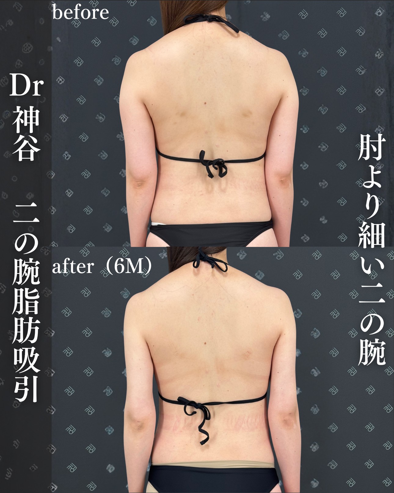 脂肪吸引ー症例写真