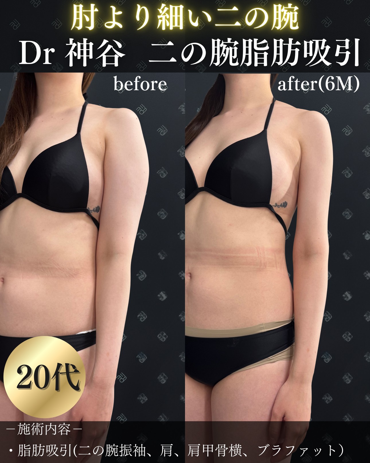 脂肪吸引ー症例写真