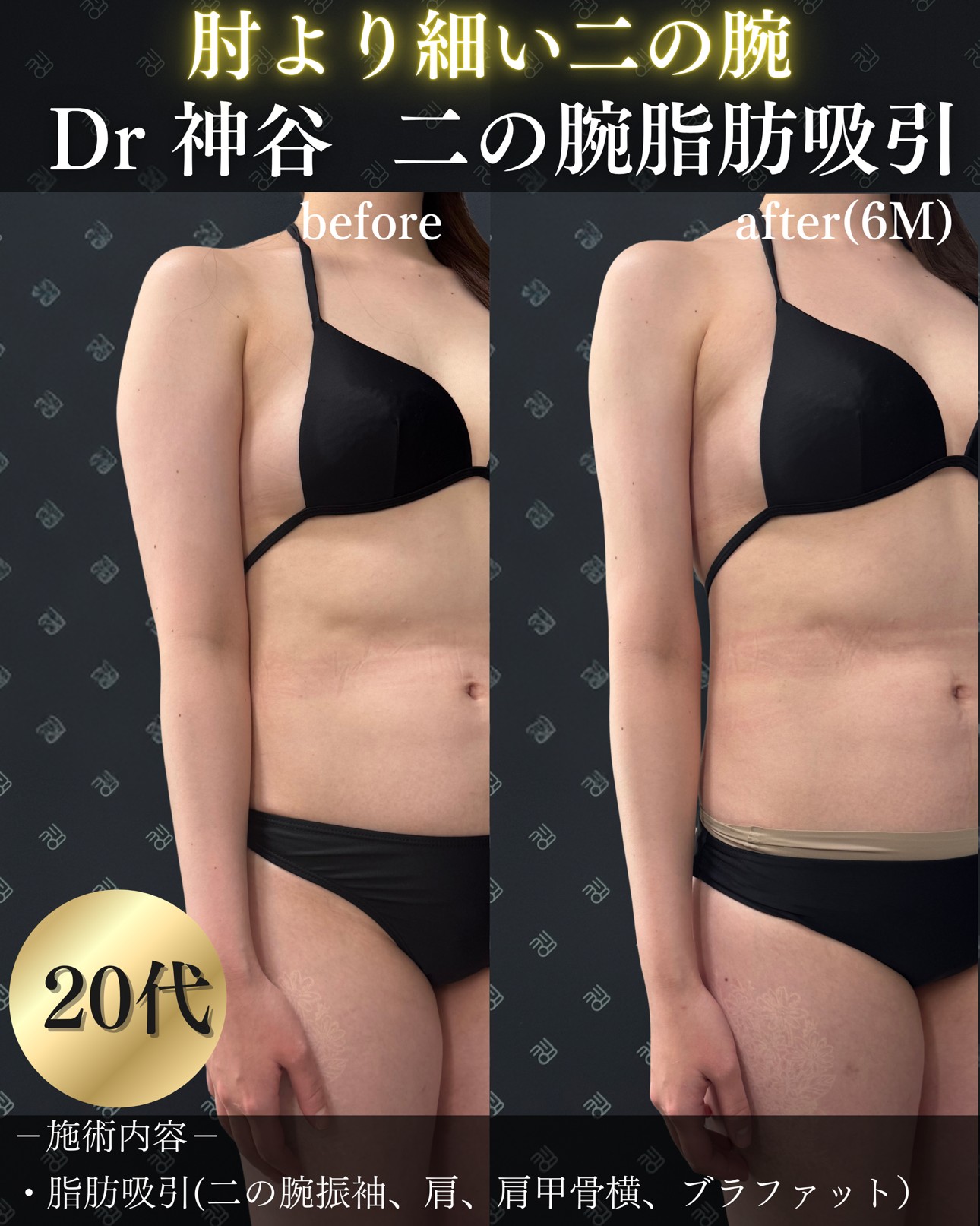 脂肪吸引ー症例写真