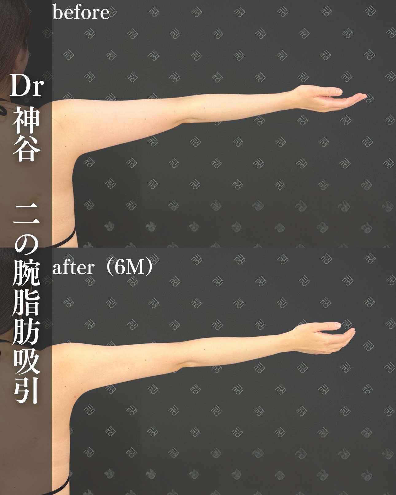 脂肪吸引ー症例写真