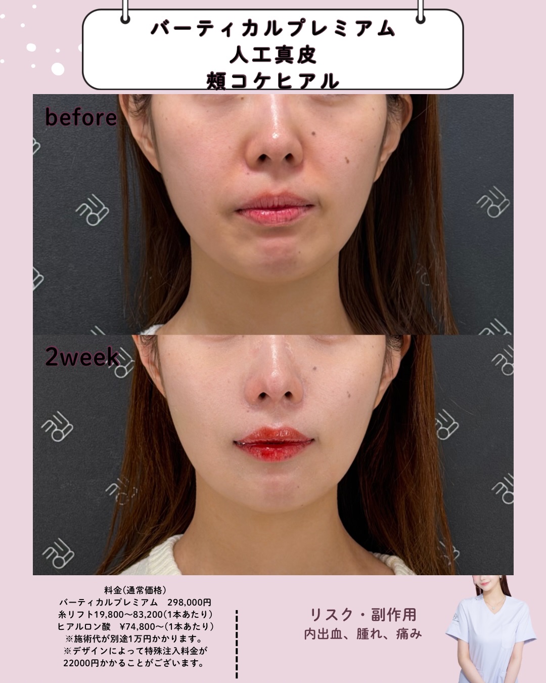 人工真皮×バーティカルプレミアム