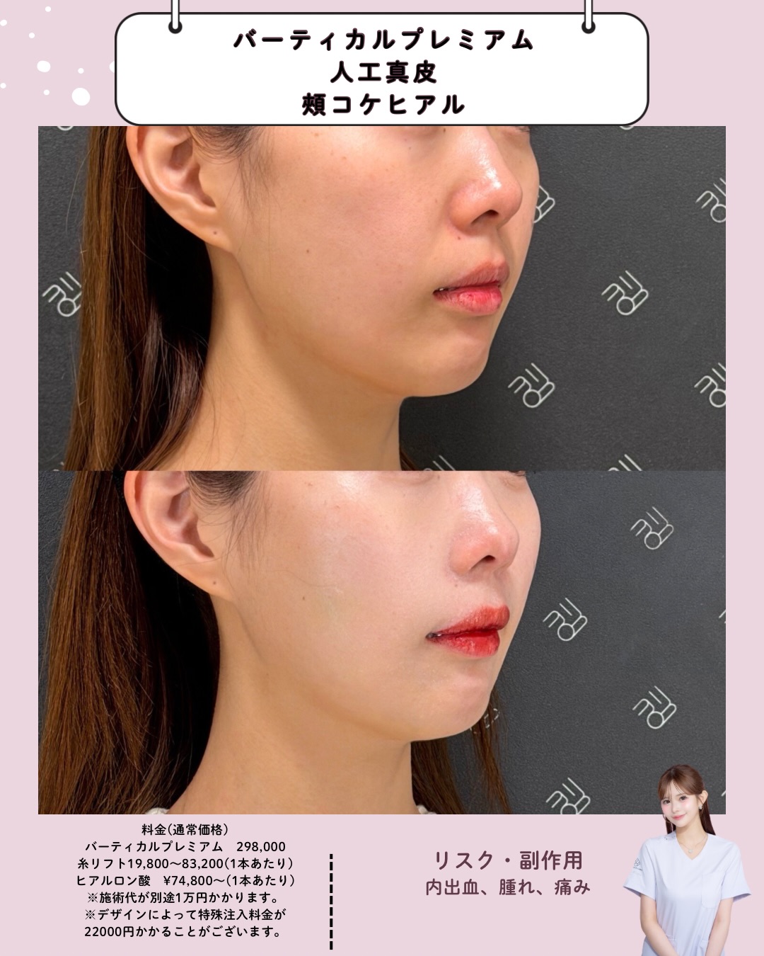 人工真皮×バーティカルプレミアム