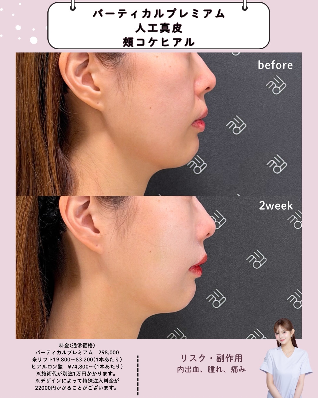 人工真皮×バーティカルプレミアム