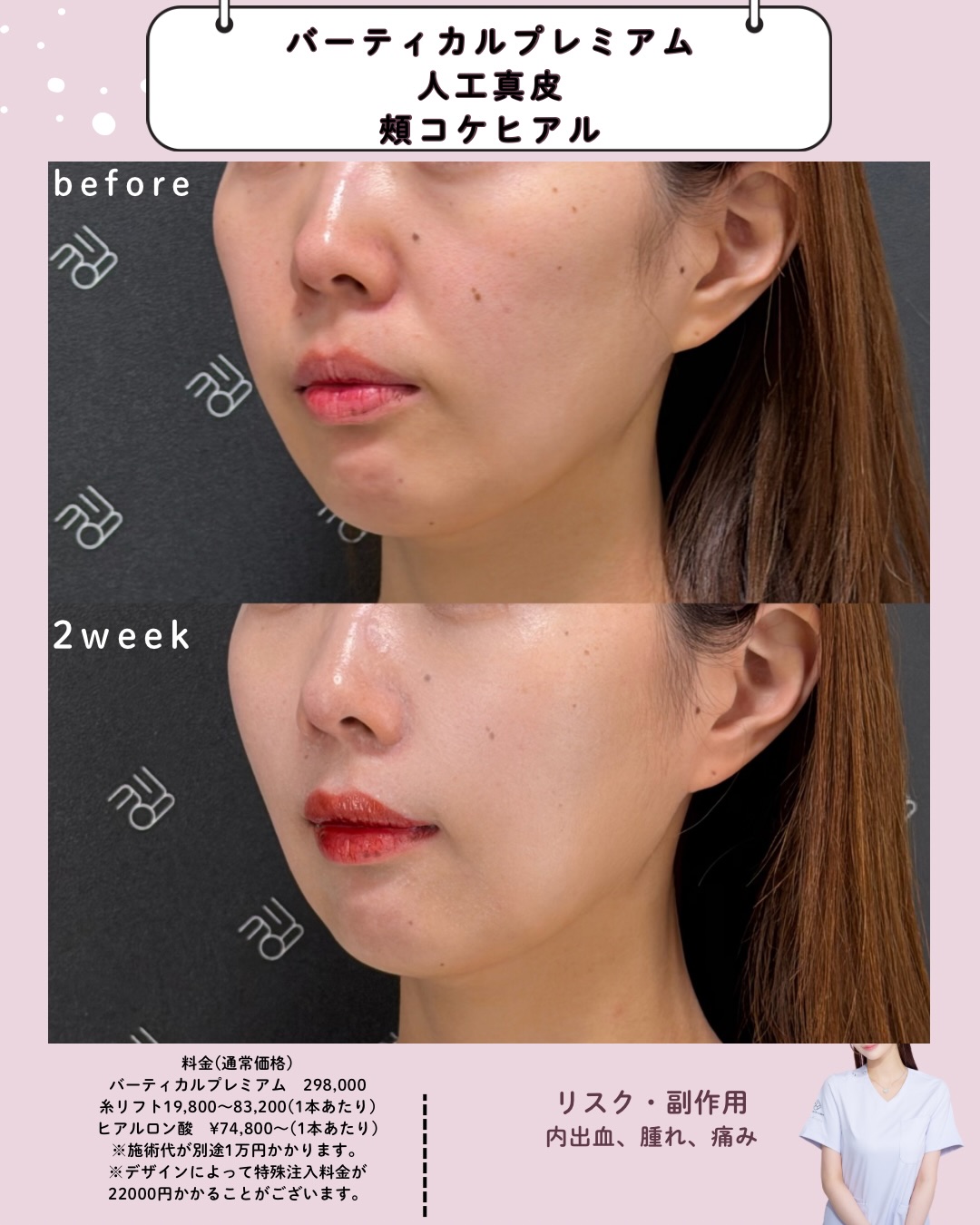 人工真皮×バーティカルプレミアム