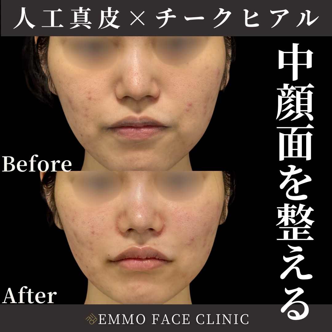 人工真皮×チークヒアルロン酸