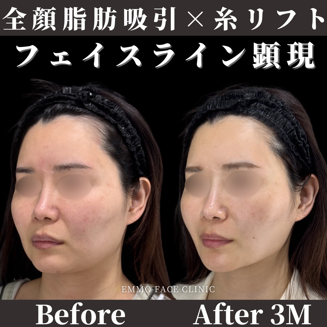 脂肪吸引×糸リフト