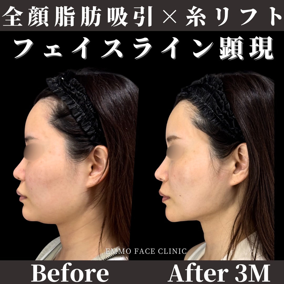 脂肪吸引×糸リフト