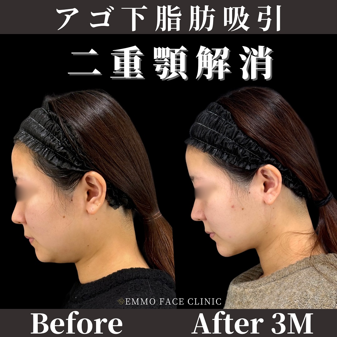 顎下脂肪吸引