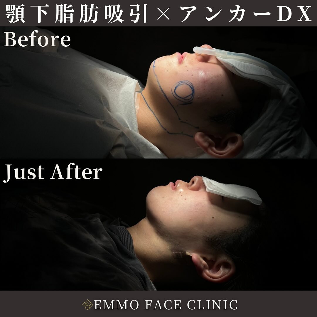 顎下脂肪吸引×糸リフト
