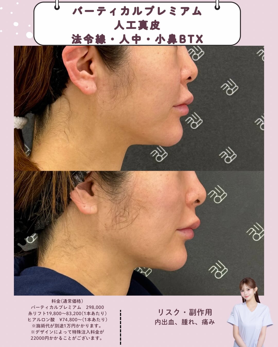 バーティカルリフトプレミアム×人工真皮