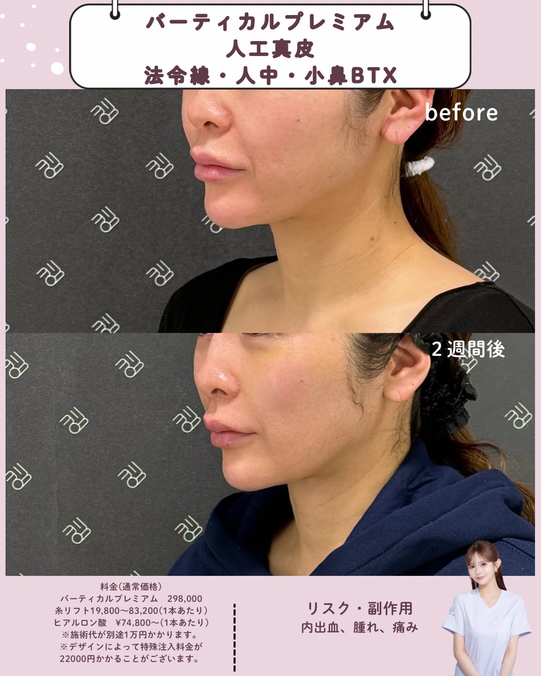 バーティカルリフトプレミアム×人工真皮