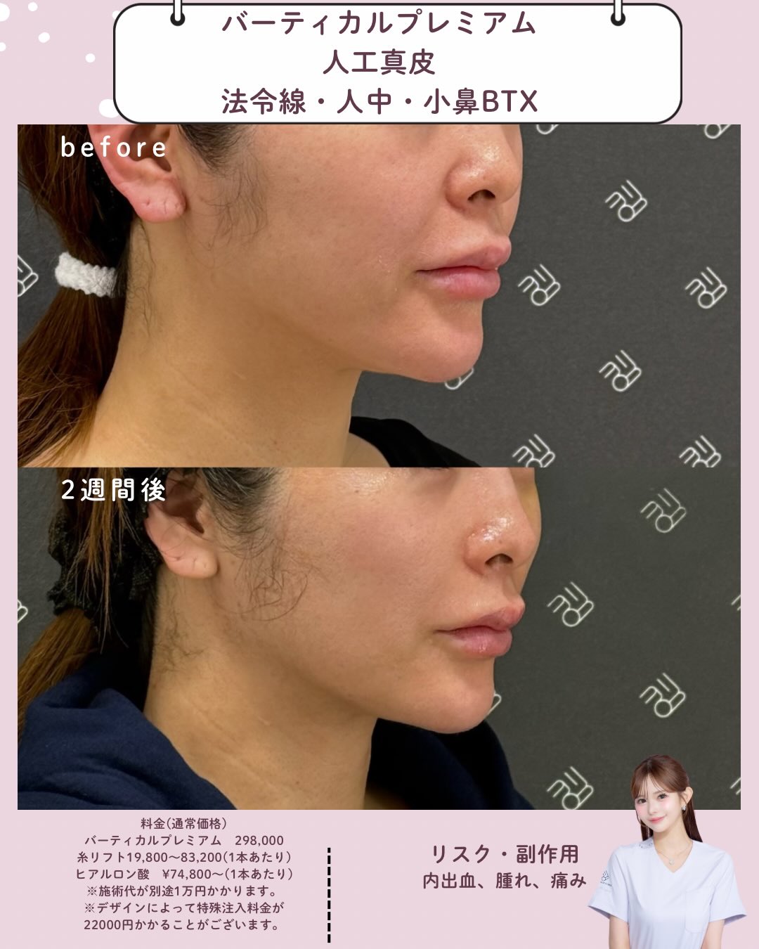 バーティカルリフトプレミアム×人工真皮