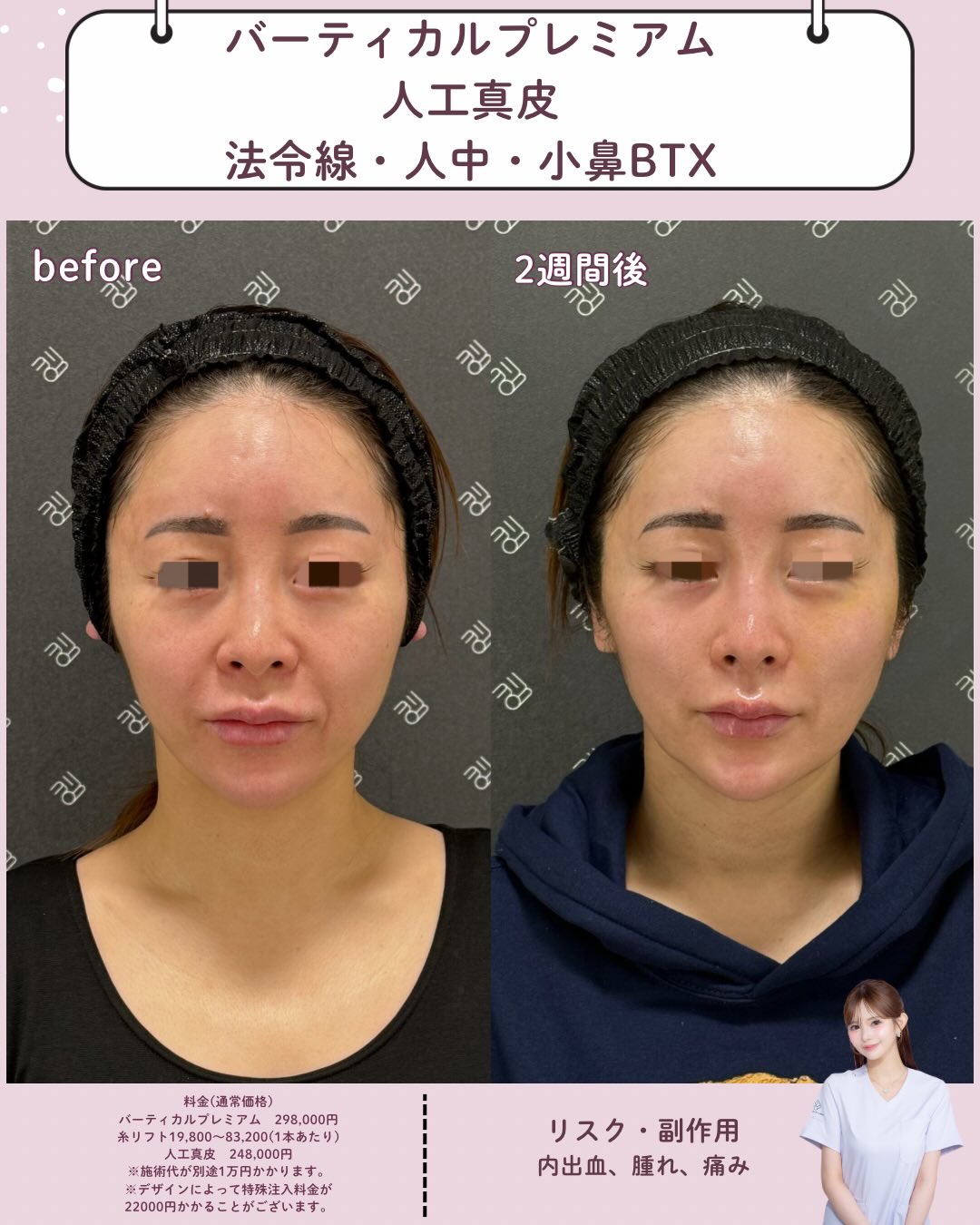 バーティカルリフトプレミアム×人工真皮