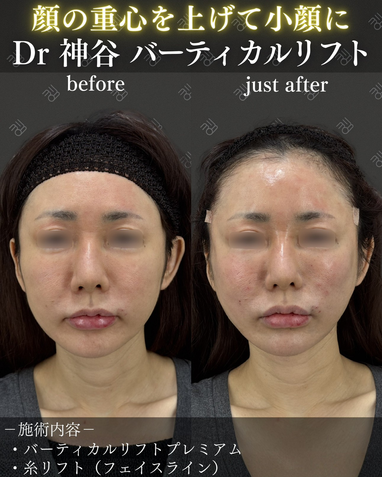 バーティカルリフトー症例写真