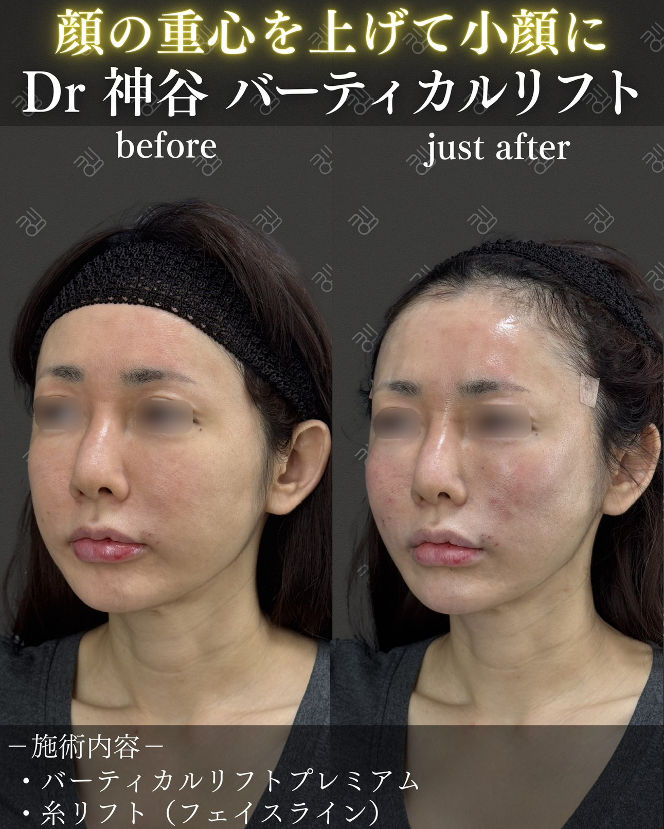 バーティカルリフトー症例写真