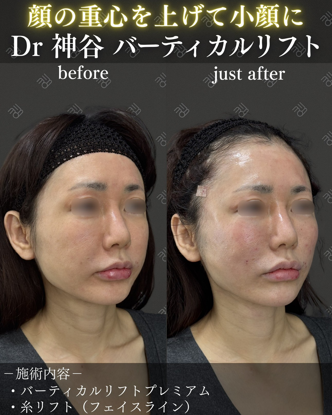 バーティカルリフトー症例写真