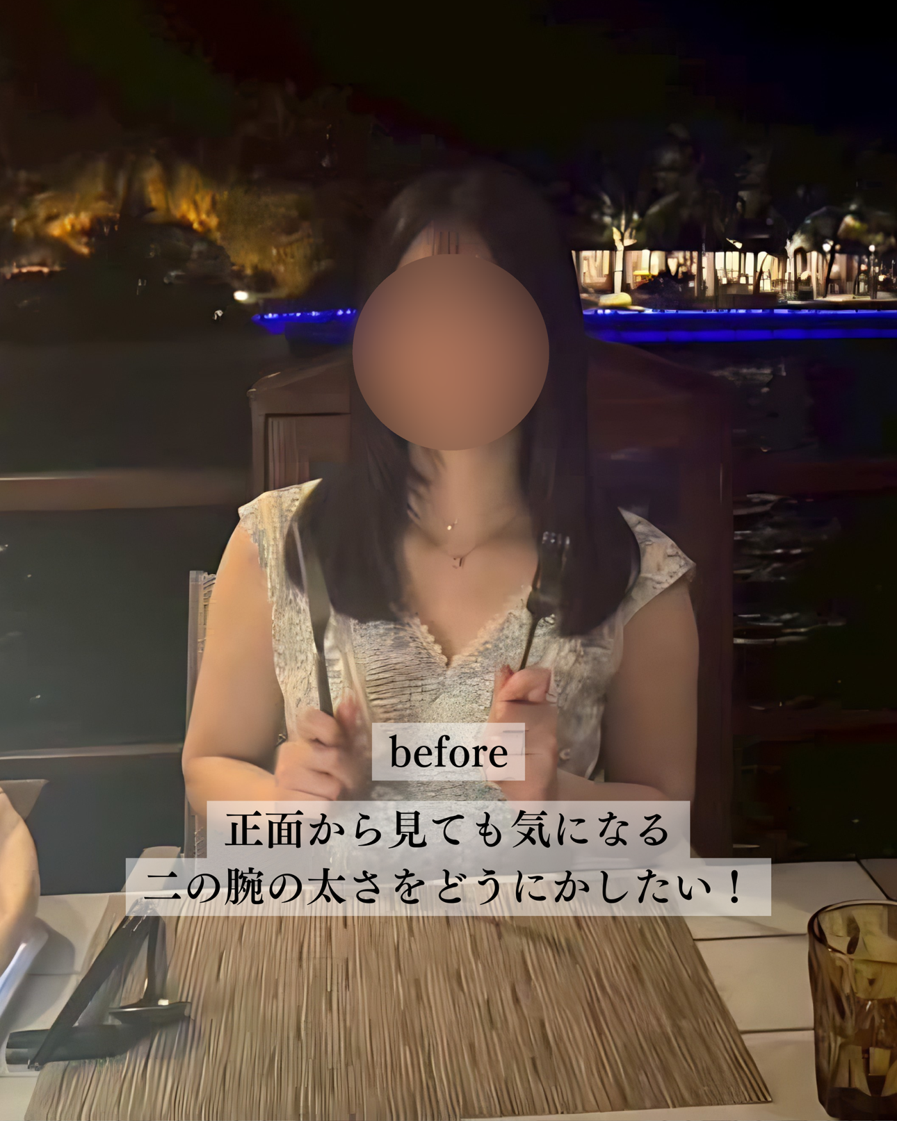 二の腕脂肪吸引ー症例写真