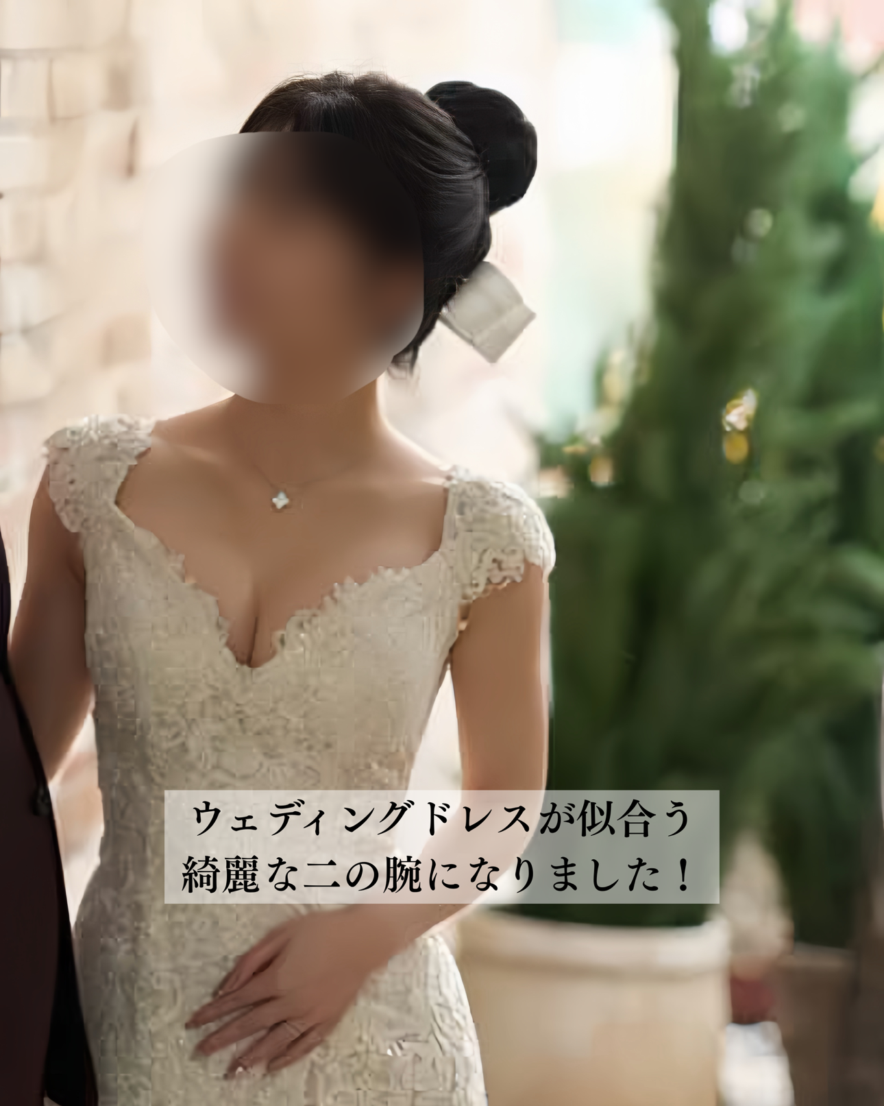 二の腕脂肪吸引ー症例写真