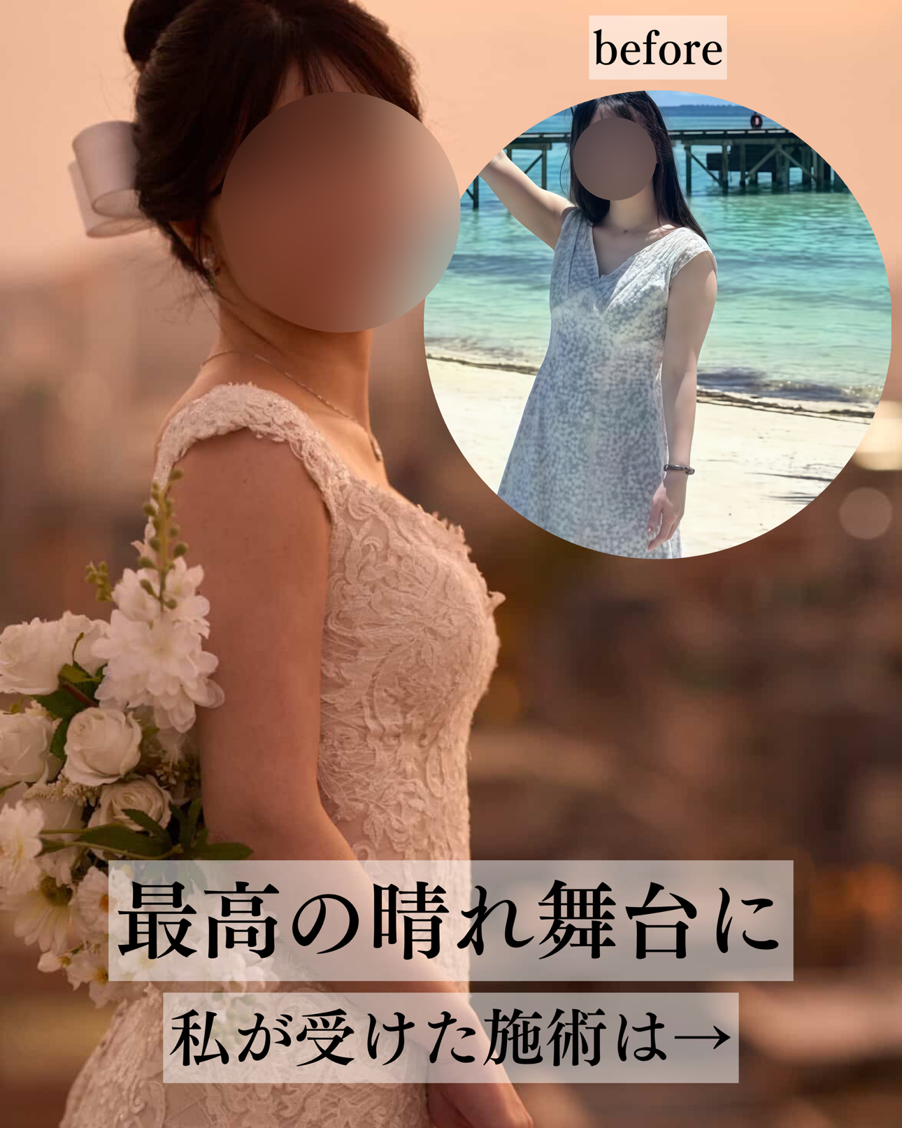 二の腕脂肪吸引ー症例写真