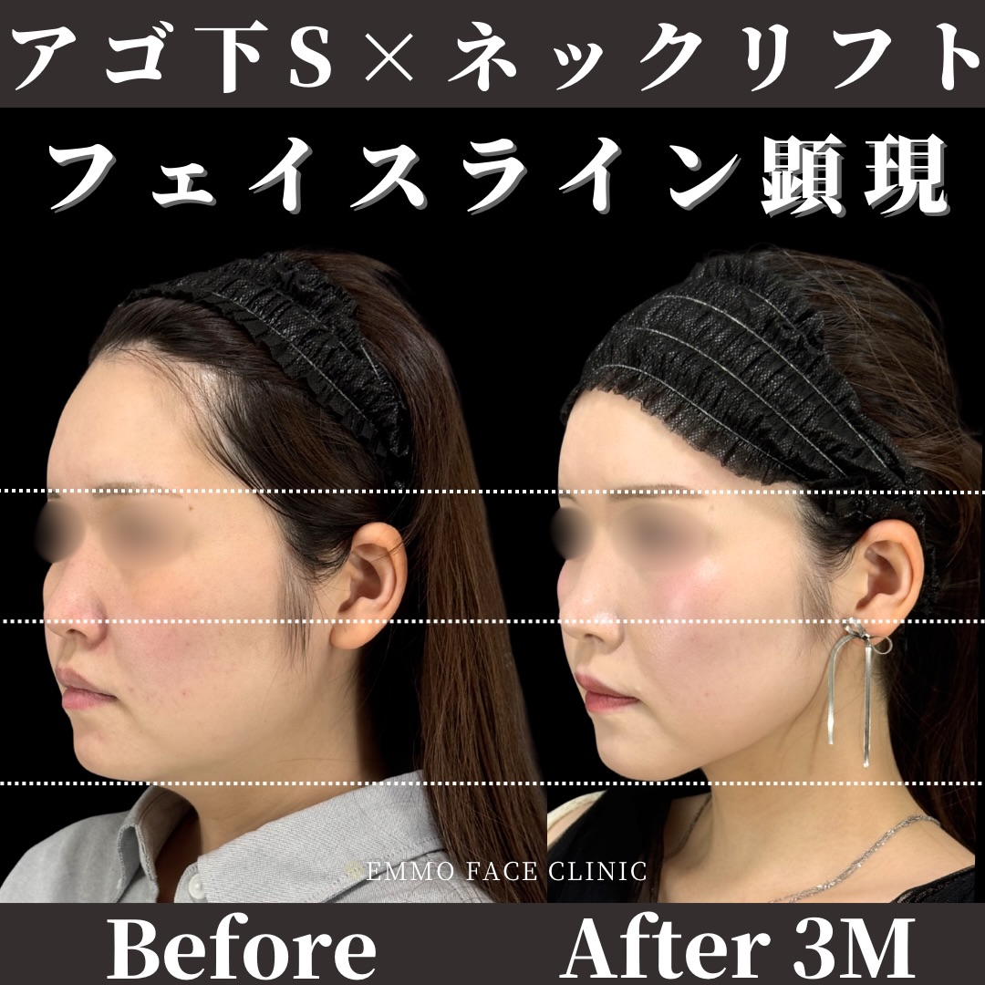 アゴ下脂肪吸引×糸リフト